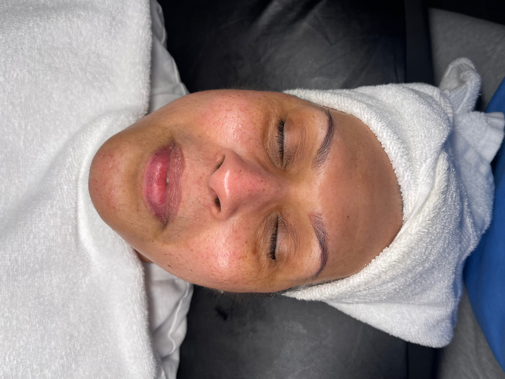 Rf Facial