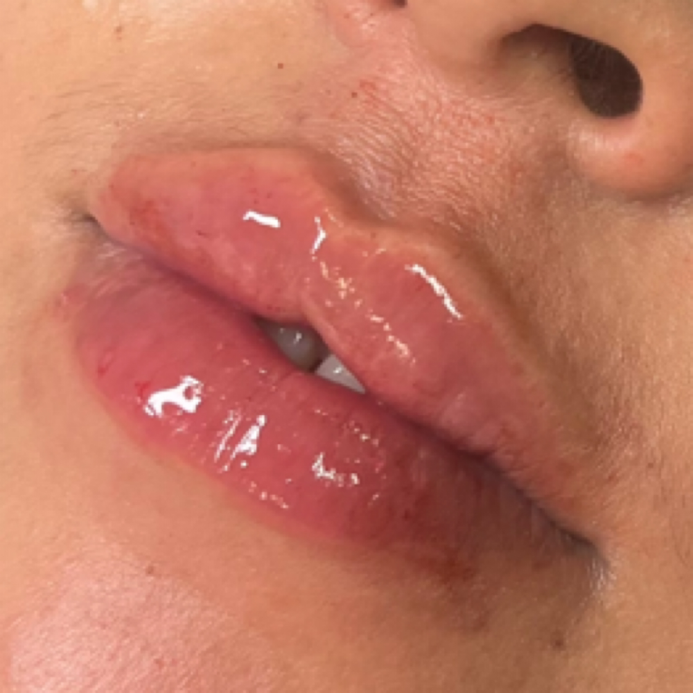 .7 ML SYRINGE •LIPS• at Glam X Sam MedBeauty in Andrews, TX