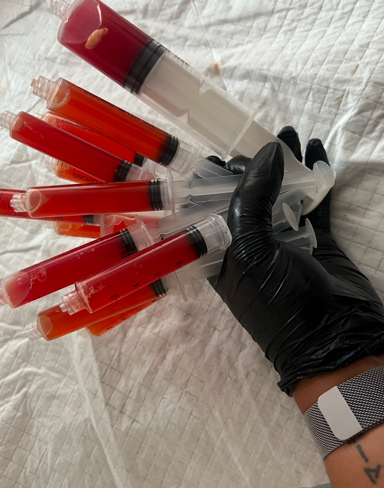 Seroma Extraction