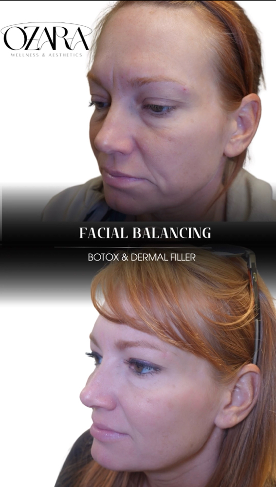 Dermal Filler