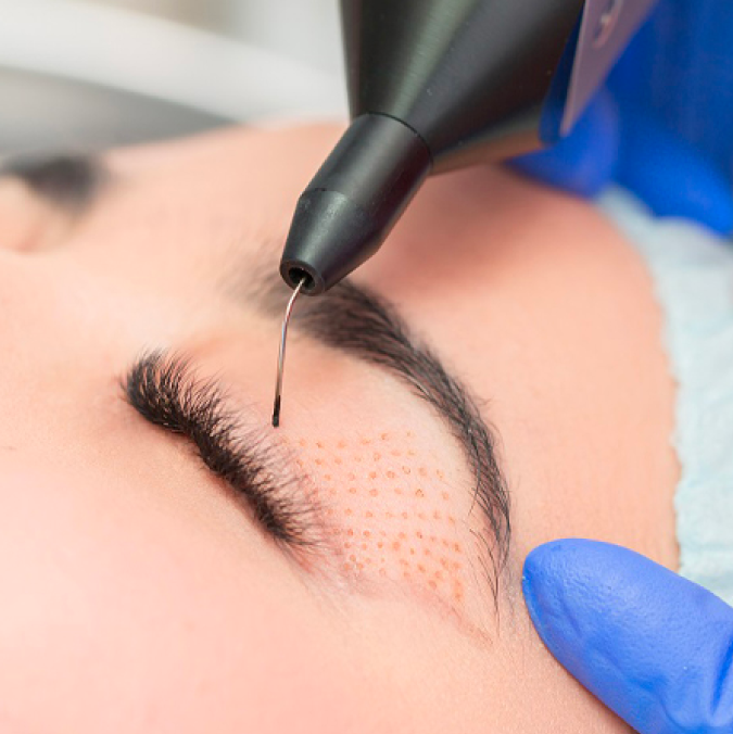 Fibroblast at Mussa Beauty by Insam in Phoenix, AZ