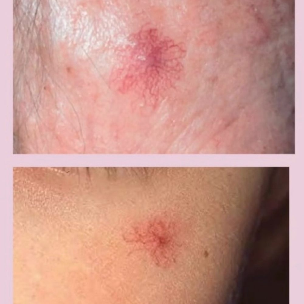 Spider Angioma at Serenity Aesthetics by Denise in St. John’s, FL