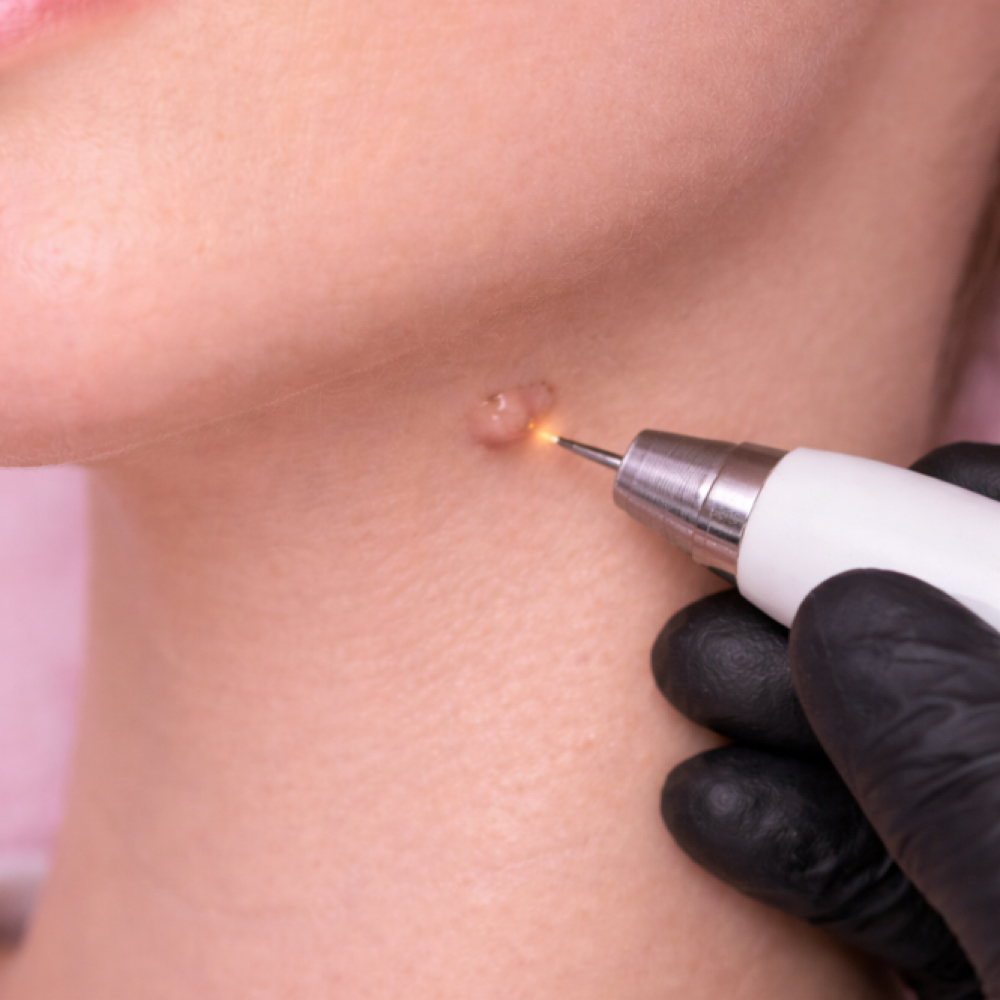 Verrugas 1-5 at Beauty Couture MedSpa in Austin, TX