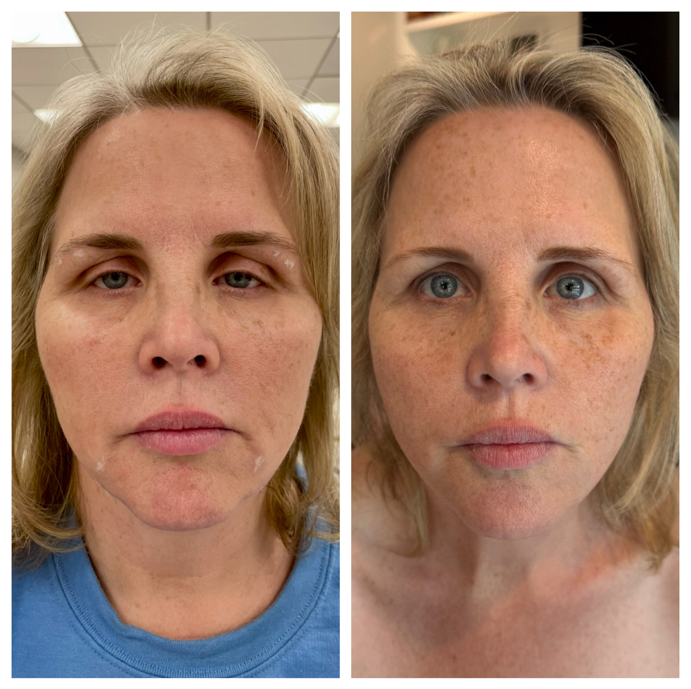 Facial Balancing at DollFace Aesthetics by Sera in West Roxbury, MA