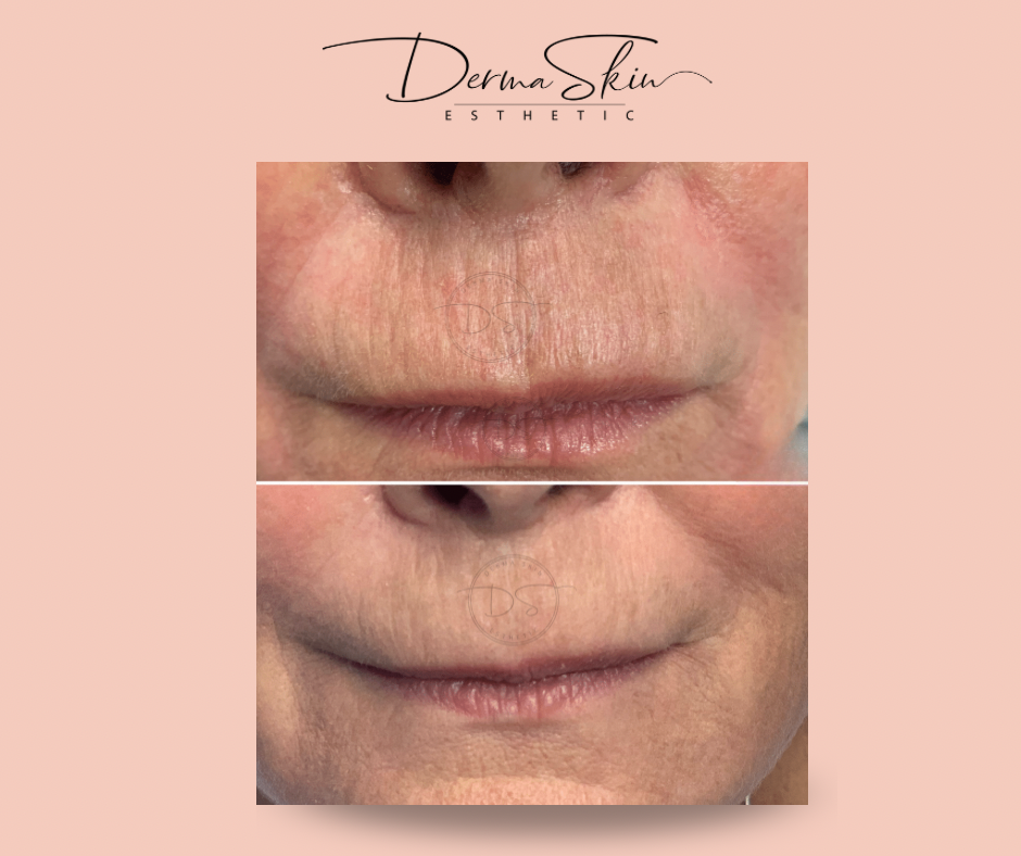 Corrección Lineas De Labio Superior