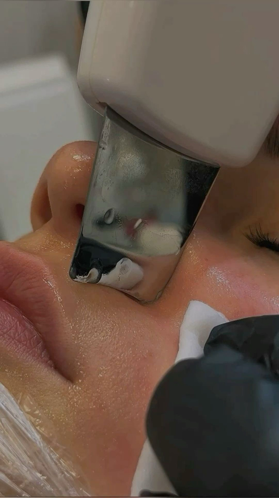Deep Pore Extractions