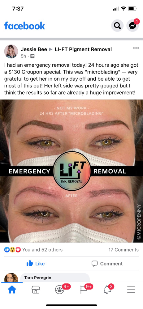 BROW TATTOO REMOVAL CONSULTATION