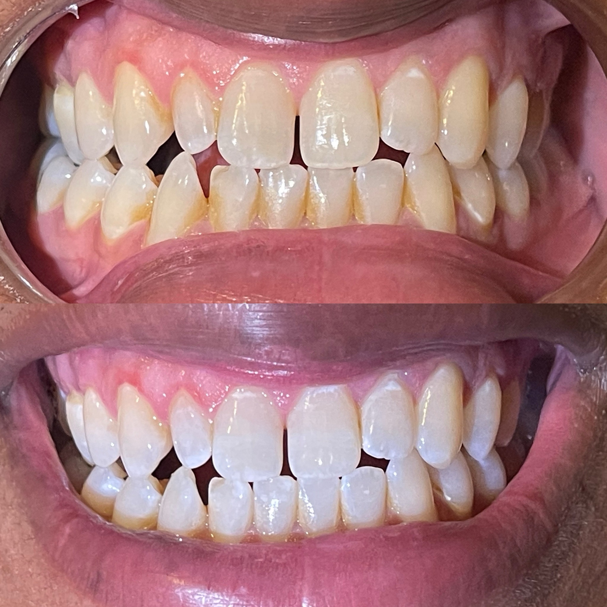 30 Minute Teeth Whitening at Smiles By Ali✨ in Arlington, TX