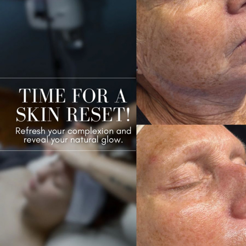 Microneedling Special For July at Flawless Finish Skin Renew in Goldsboro, NC