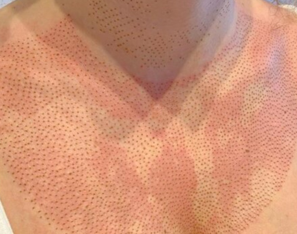 Plasma - chest