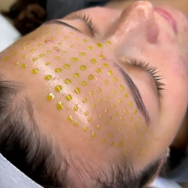 Microneedling with BioRePeel at Skin Fix Aesthetics LA in Studio City, CA