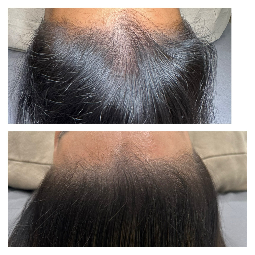 Hair Regrowth Stimulation Treatment