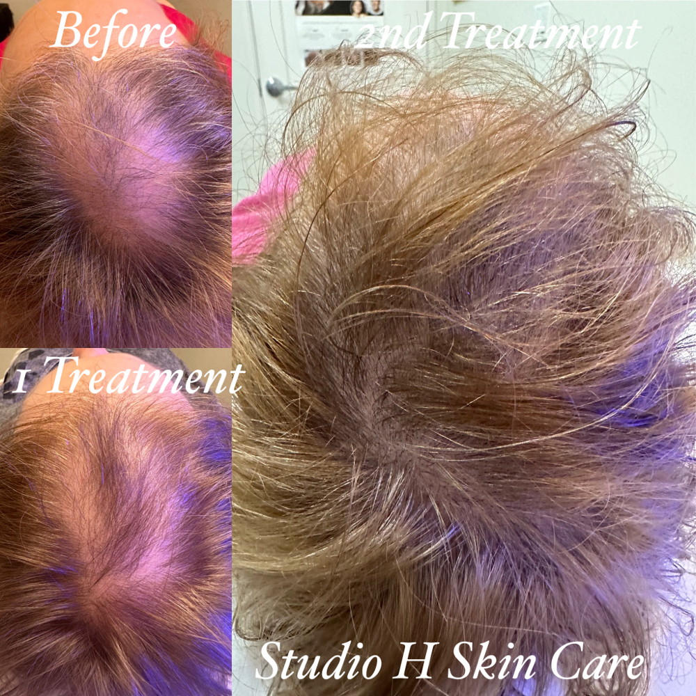 Keravive 1/2 Scalp Treatment