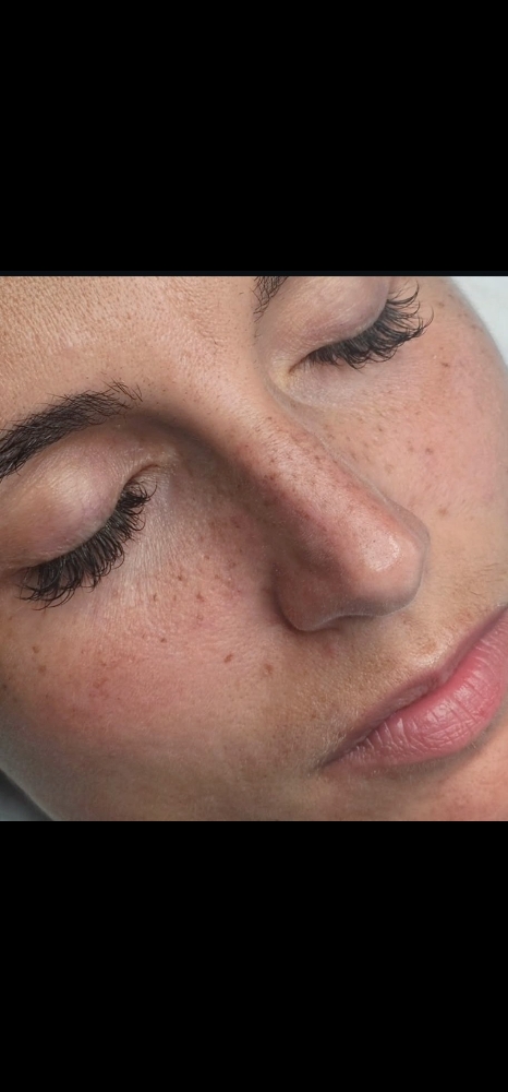 Freckles