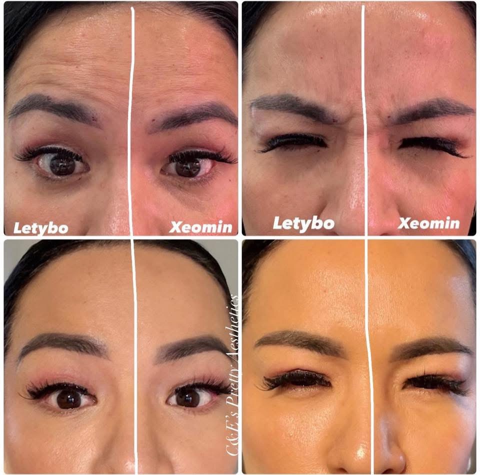 Letybo/Xeomin (Neurotoxin) at Safe Haven MedSpa in McAllen, TX