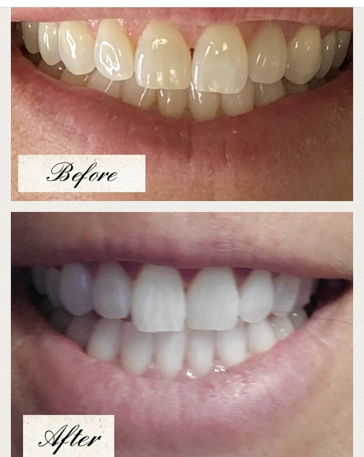 Teeth Whitening