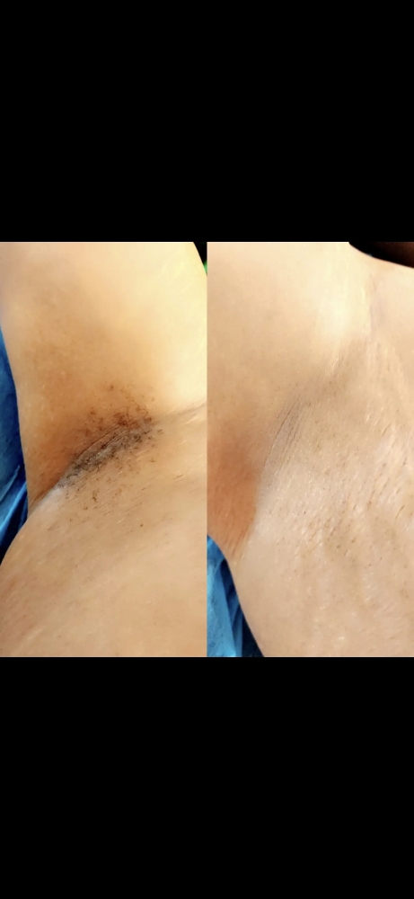 Underarm Wax