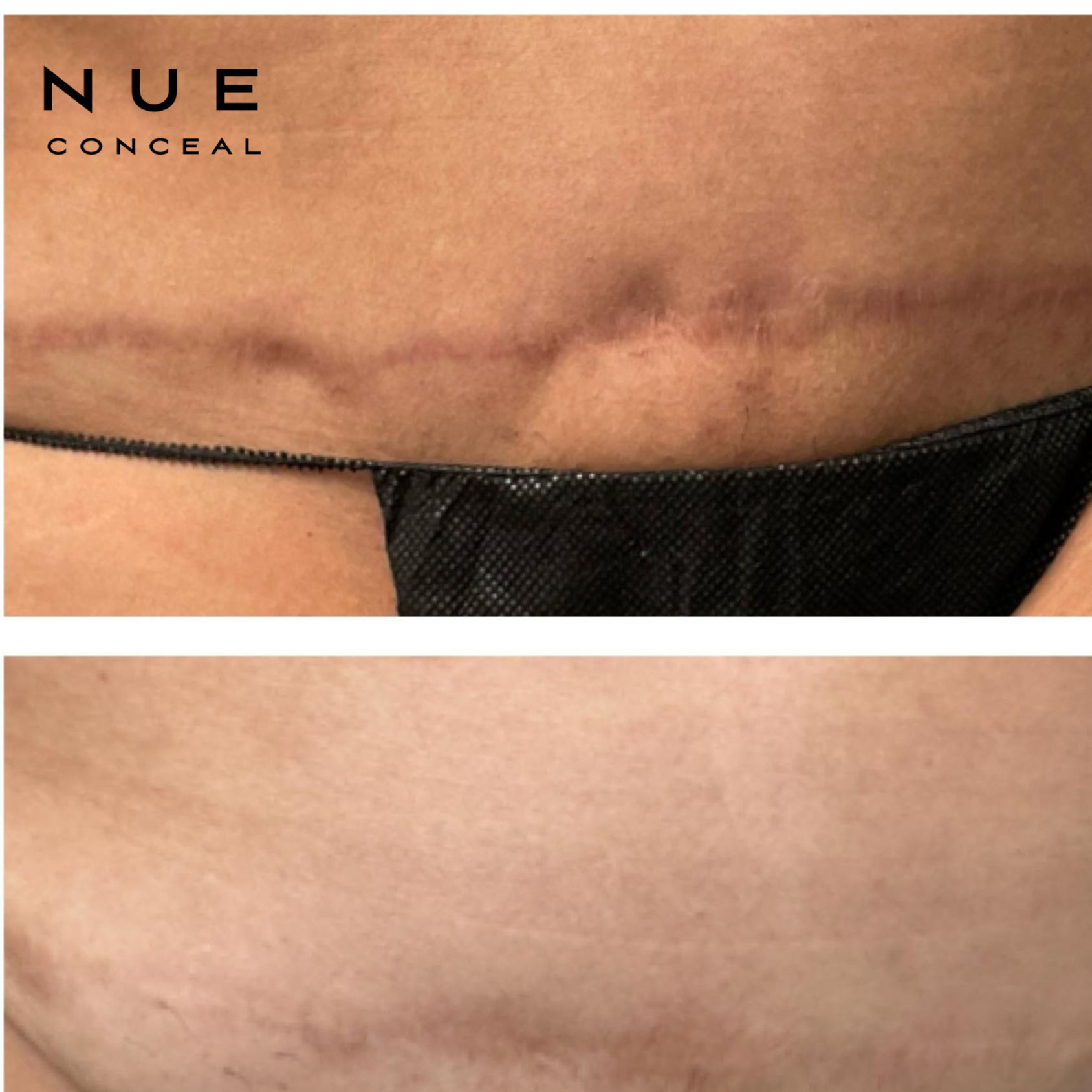 Tummy Tuck 180* Scar Revision at Pamper Me Ink  Paramedical Tattooing in Tucson, AZ