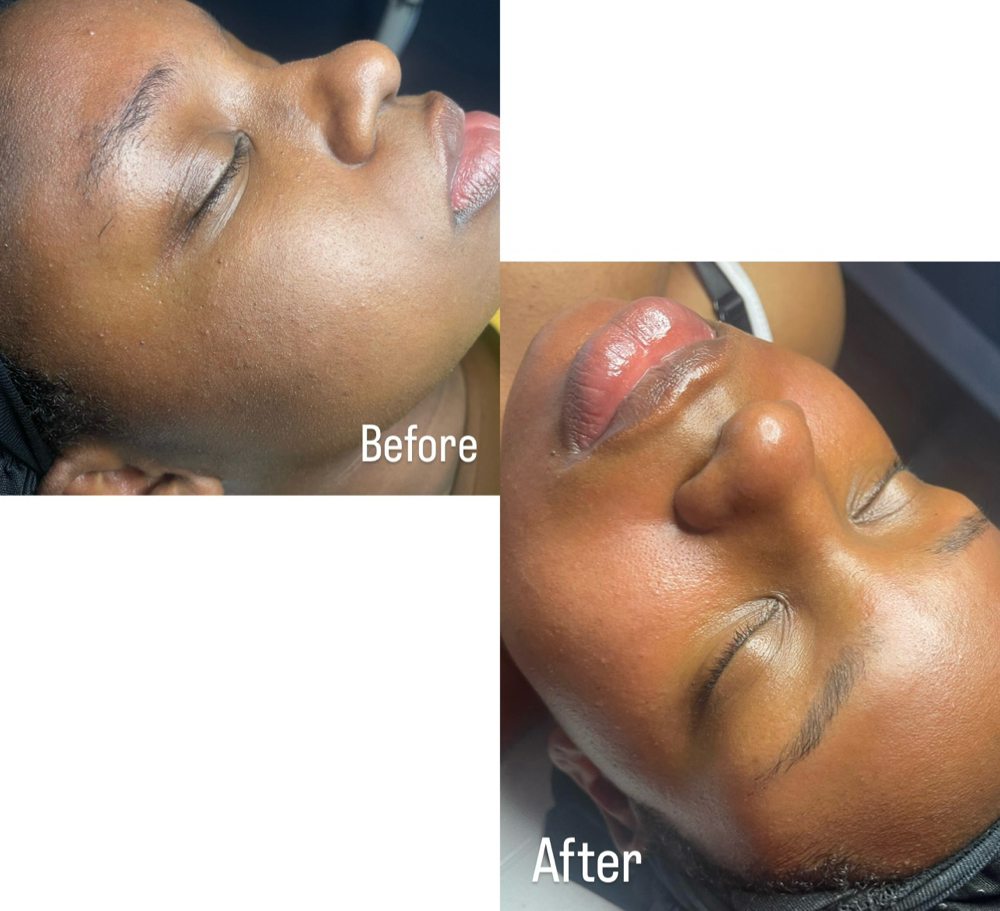Total Reboot Facial