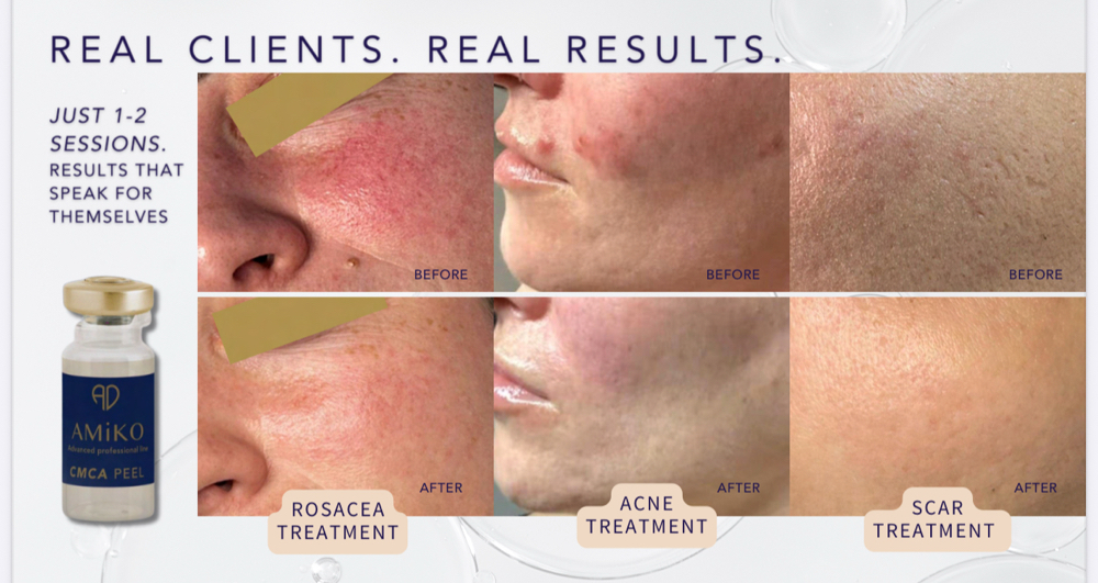 NEW! AMiKO Colostrum Peel