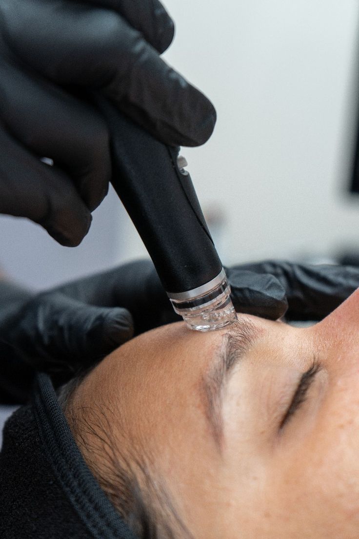 Microchanneling facial