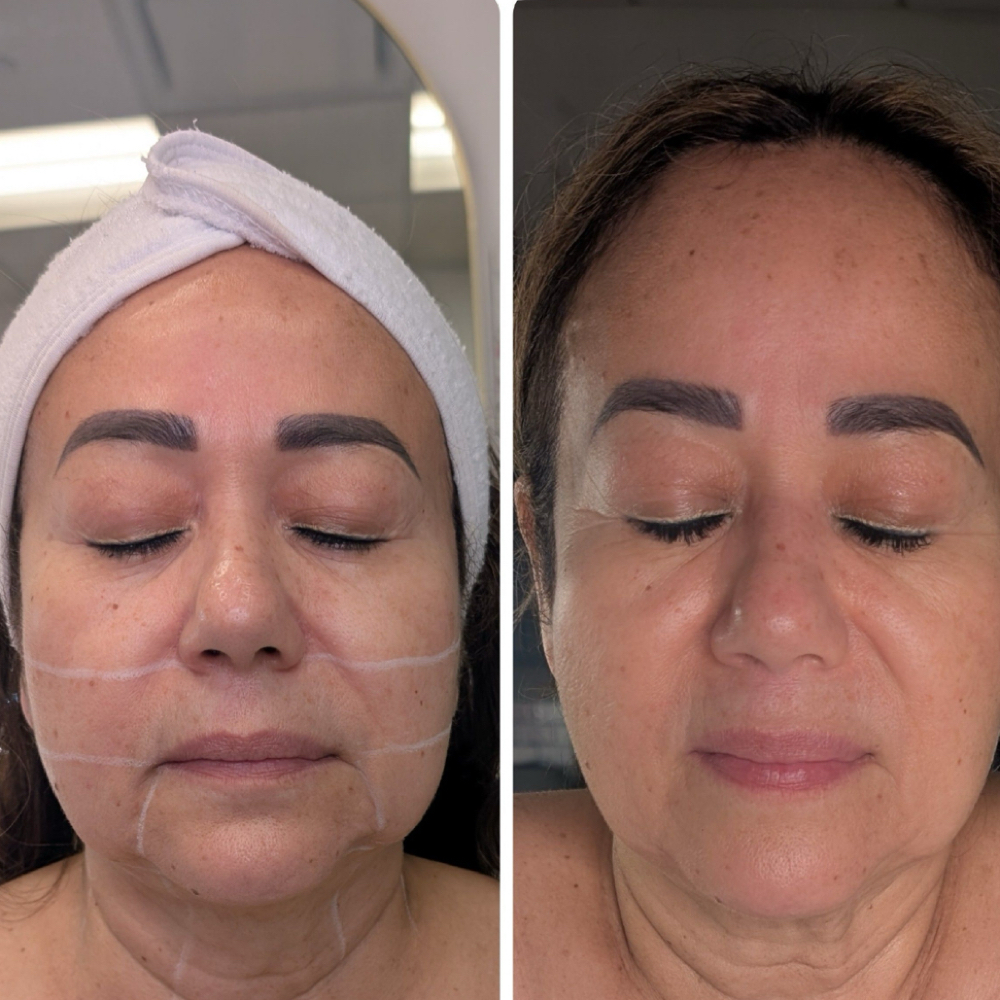 Facial Rejuvenation + Aesthetic Machines at Nenusk Aesthetics in Long Island City, NY