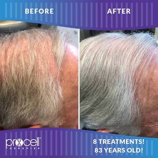 Procell Microchannelling Scalp