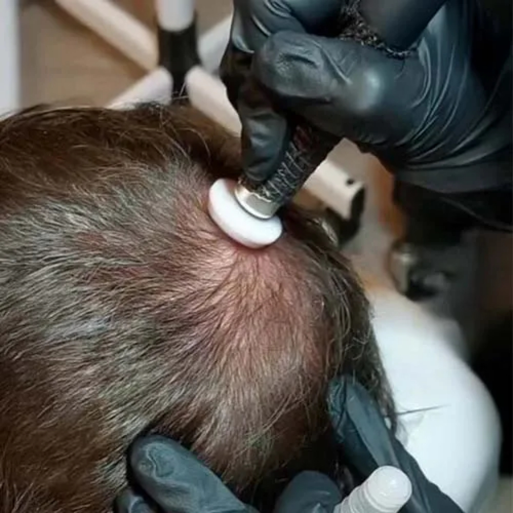 Scalp Microchannel at VI LA Studio Spa in San Jose, CA