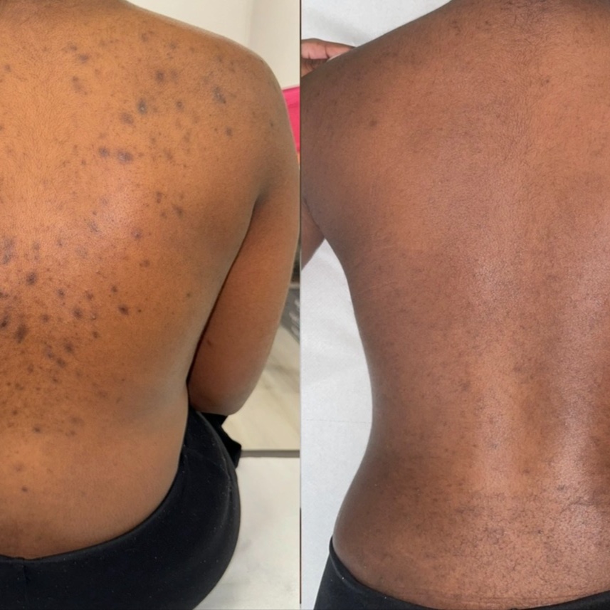Organo Herbal Peel (Back) at Velnaira in Lakewood, CA