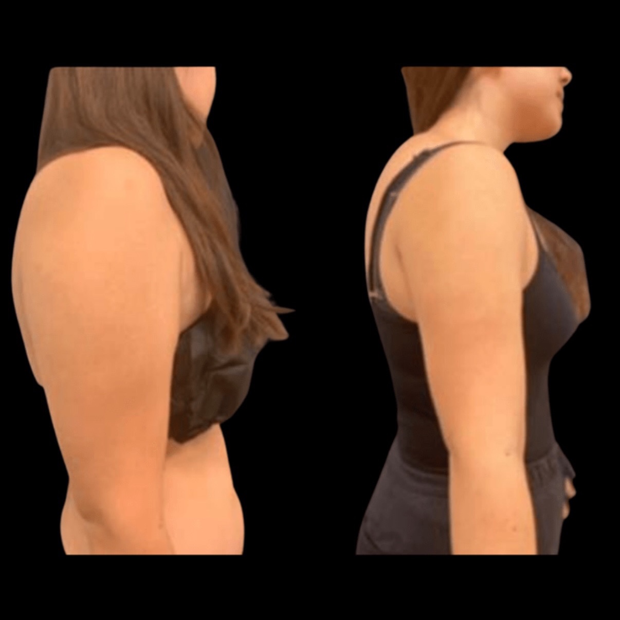 Lipo 360 Arms at Gold Stone Beauty in mcallen, TX