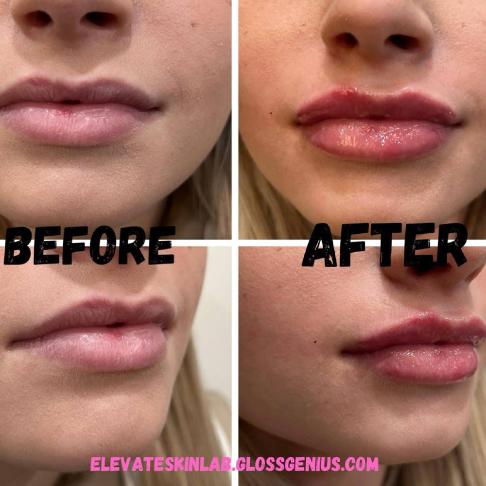 Lip Filler: 1/2 Syringe at Elevate Skin Lab in Desloge, MO