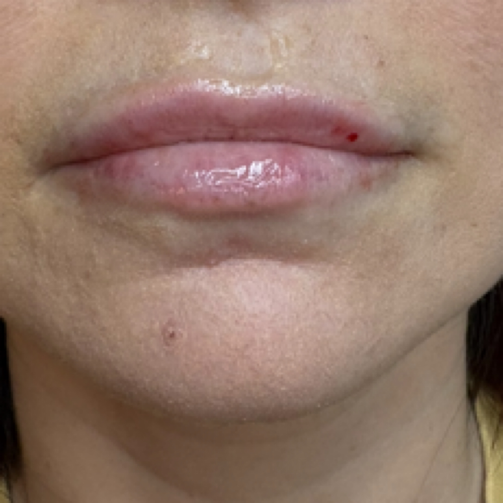 Lip Filler: 1/2 Syringe