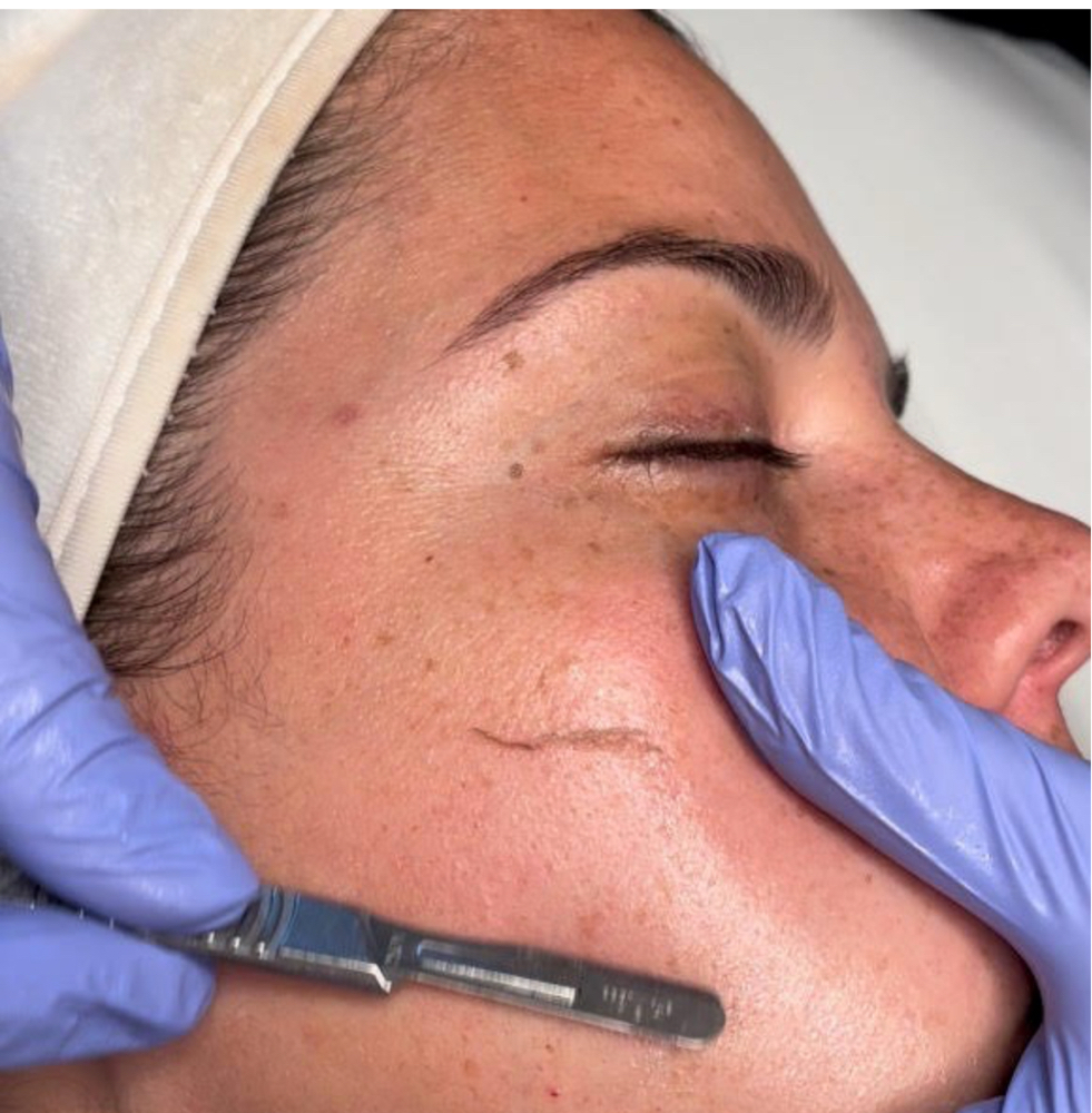 Dermplane (only)
