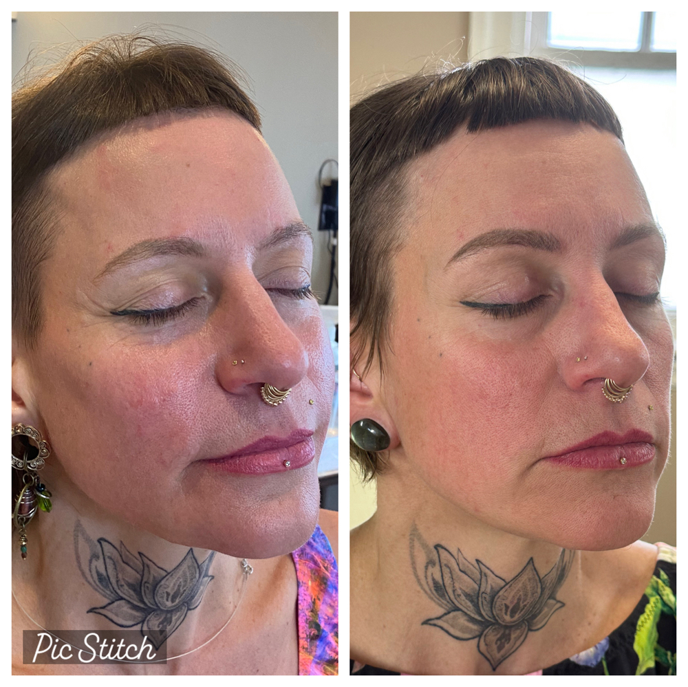 Collagen Stimulators at Aesthetic NP Marie in Portland, OR