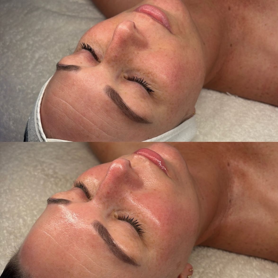 Microneedling Facial at JE Beauty & spa in duluth, GA