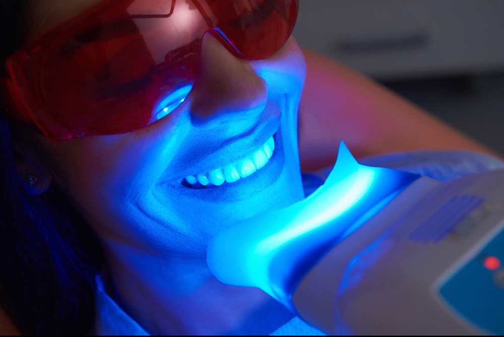 30 Min Teeth Whitening