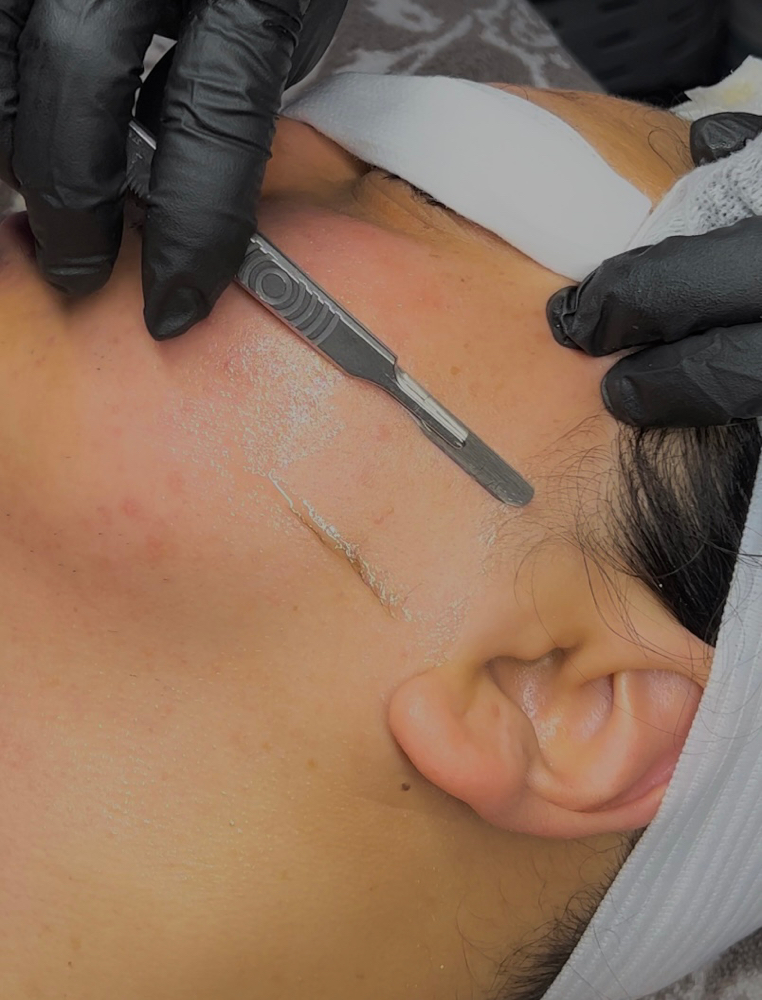 Dermaplaning