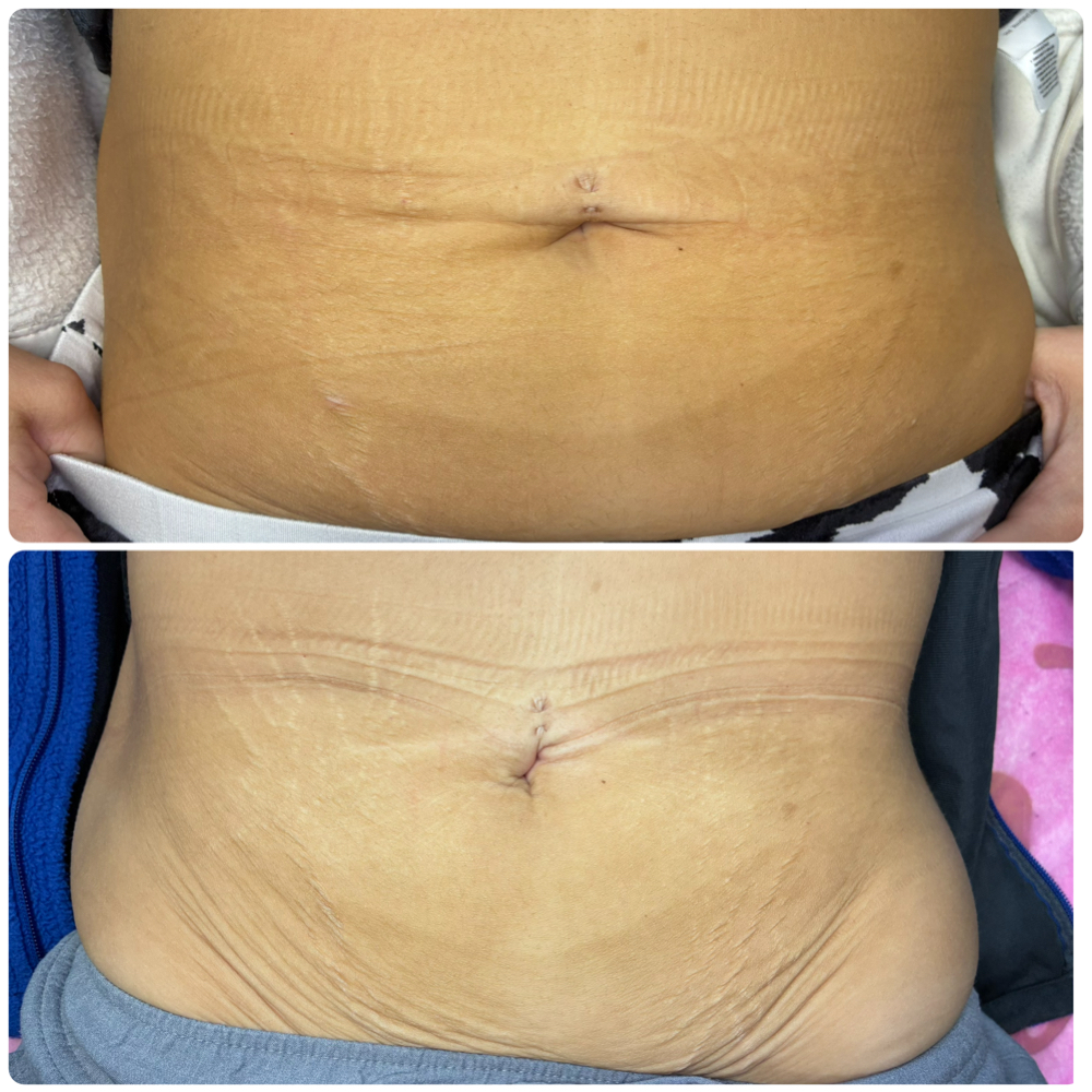 (ISR) Inkless Stretchmark Revision at Holistic Beauty in Hammond, IN