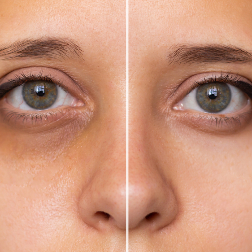 Bright Eyes Renewal Peel at Loba Beauty Spa in Paterson, NJ
