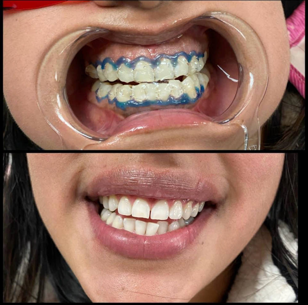 Teeth Whitening 45 Min