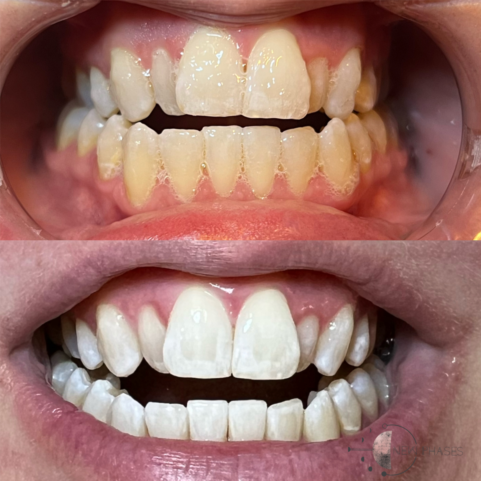 Teeth Whitening 90 min