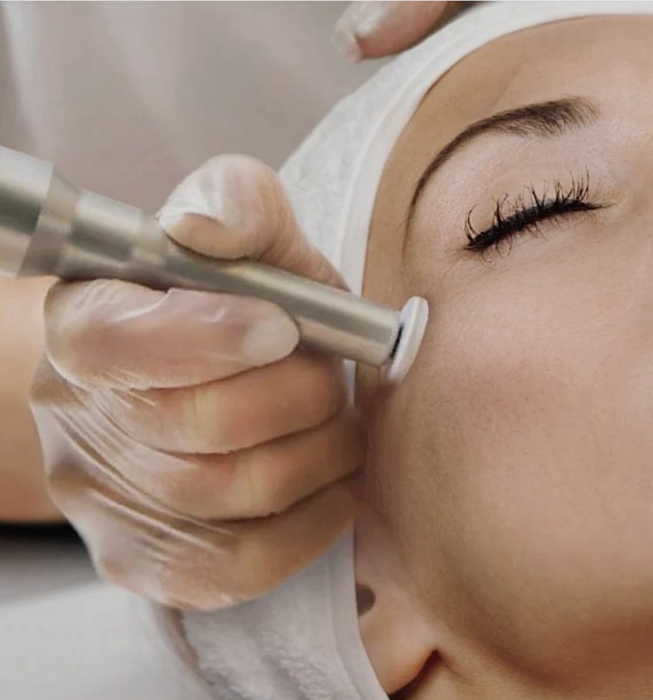 Microneedling/Microchanneling