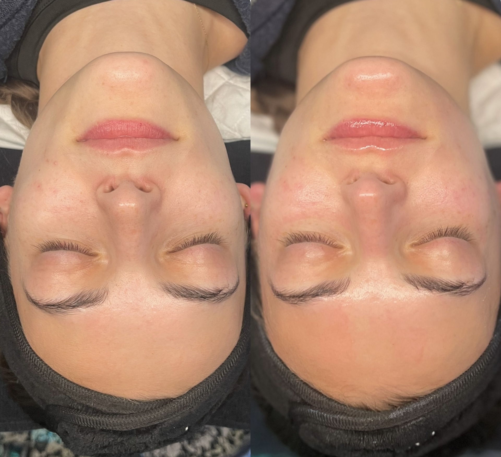 Brightening Hydrafacial