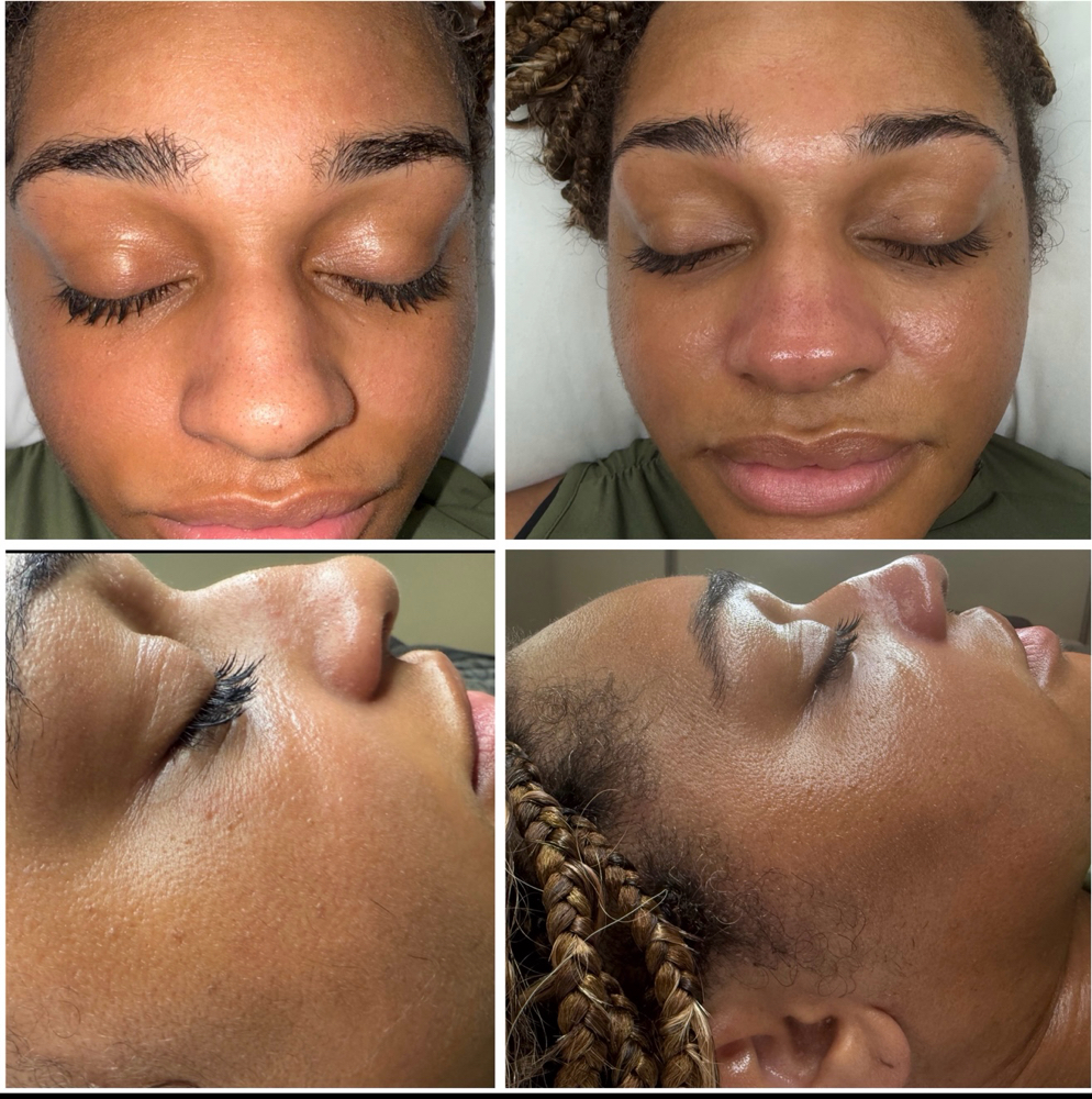 HydraFacial Glow