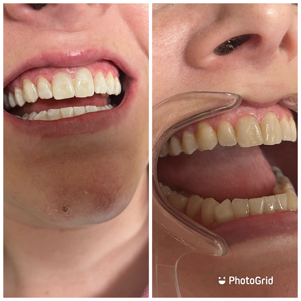Teeth Whitening