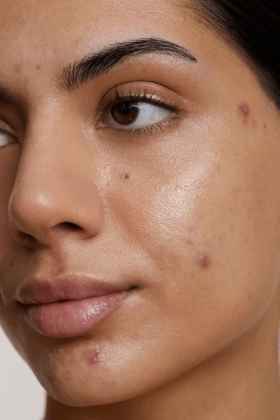 Acne/Purifying Facial at Skin Studio LLC in Pueblo, CO