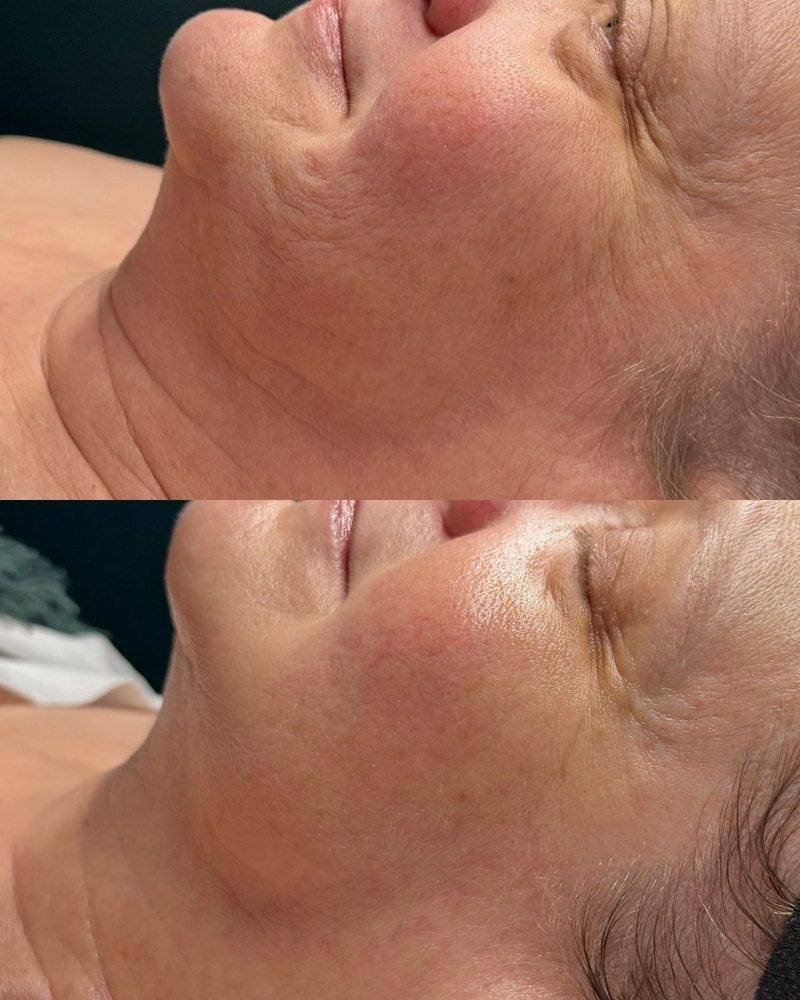 Anti-Age Facial