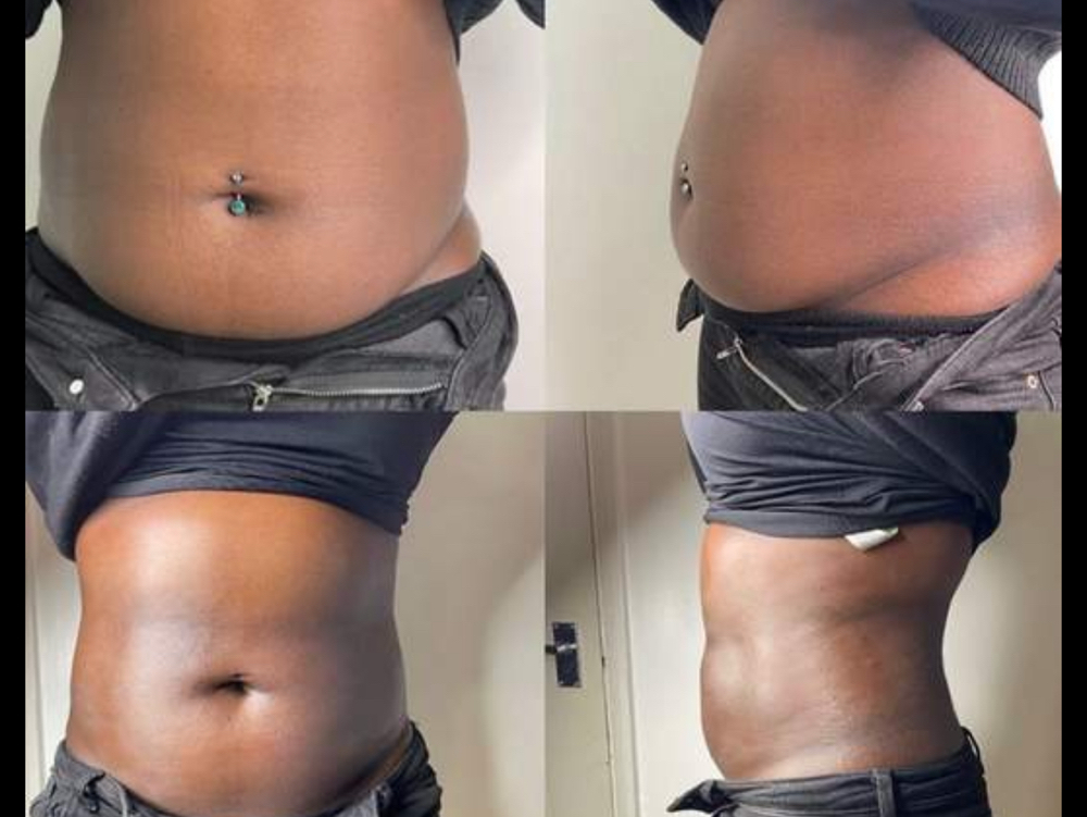 Body Sculpting