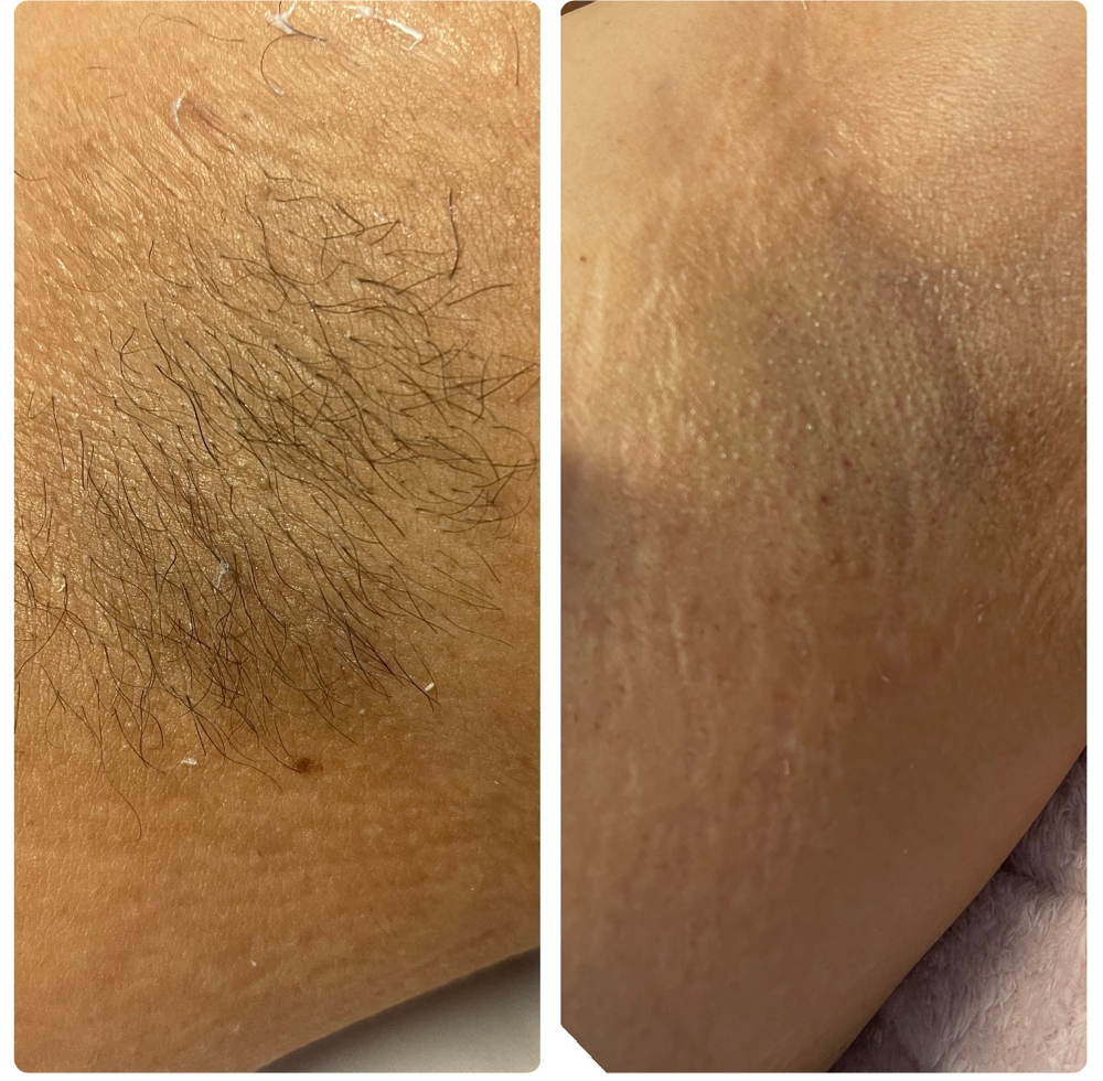 Underarm Wax