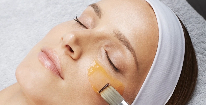 Chemical Peel